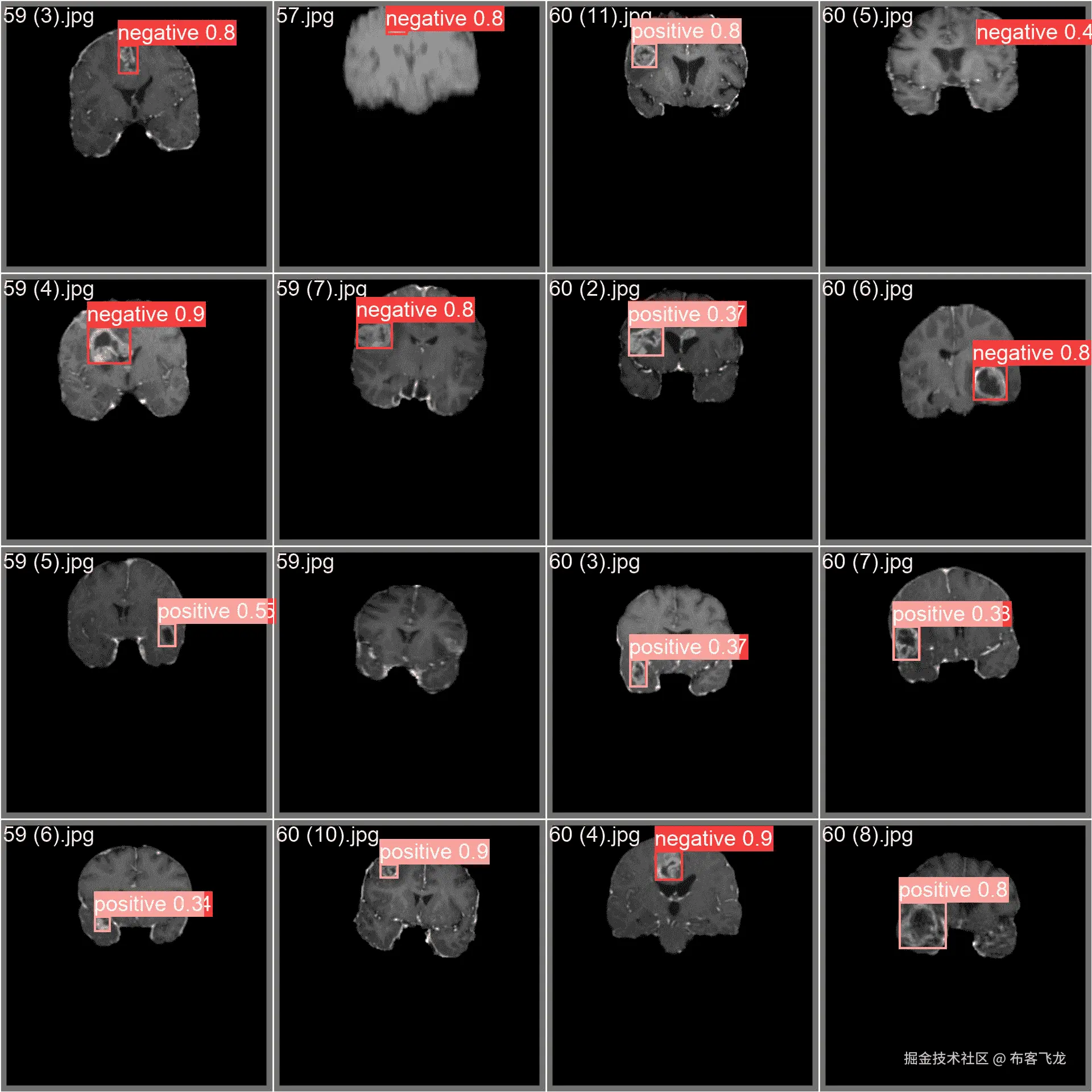 脑瘤数据集样本图像